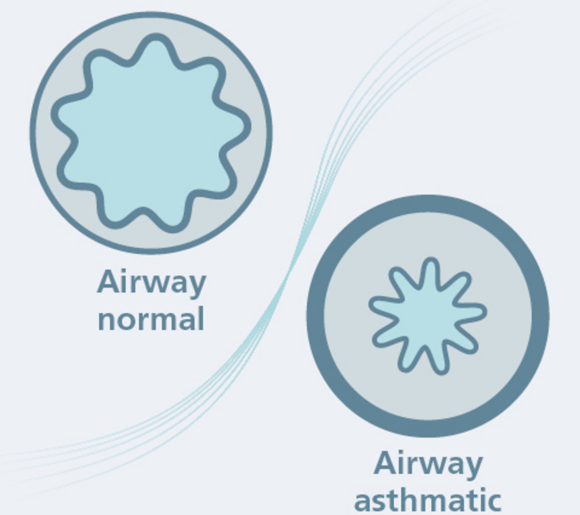 哮喘究竟是怎么回事？