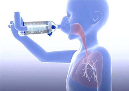 Mensch inhaliert Asthmaspray mit Spacer, schematische Verteilung des Aerosols in den Atemwegen ist zu sehen