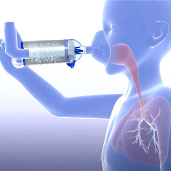 Mensch inhaliert Asthmaspray mit Spacer, schematische Verteilung des Aerosols in den Atemwegen ist zu sehen