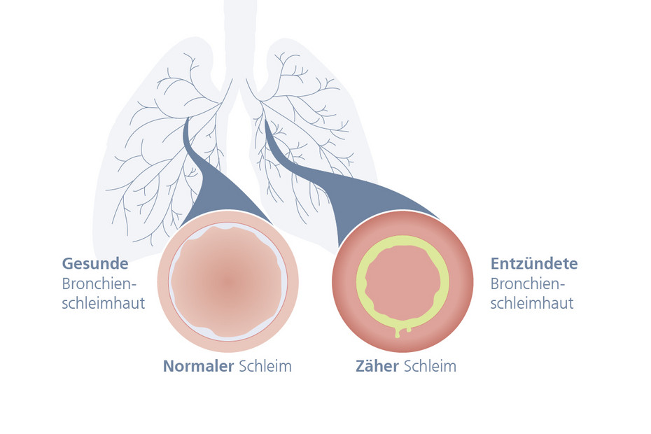 Grafischer Querschnitt der Bronchien, links mit gesunder, rechts mit entzündeter Bronchialschleimhaut