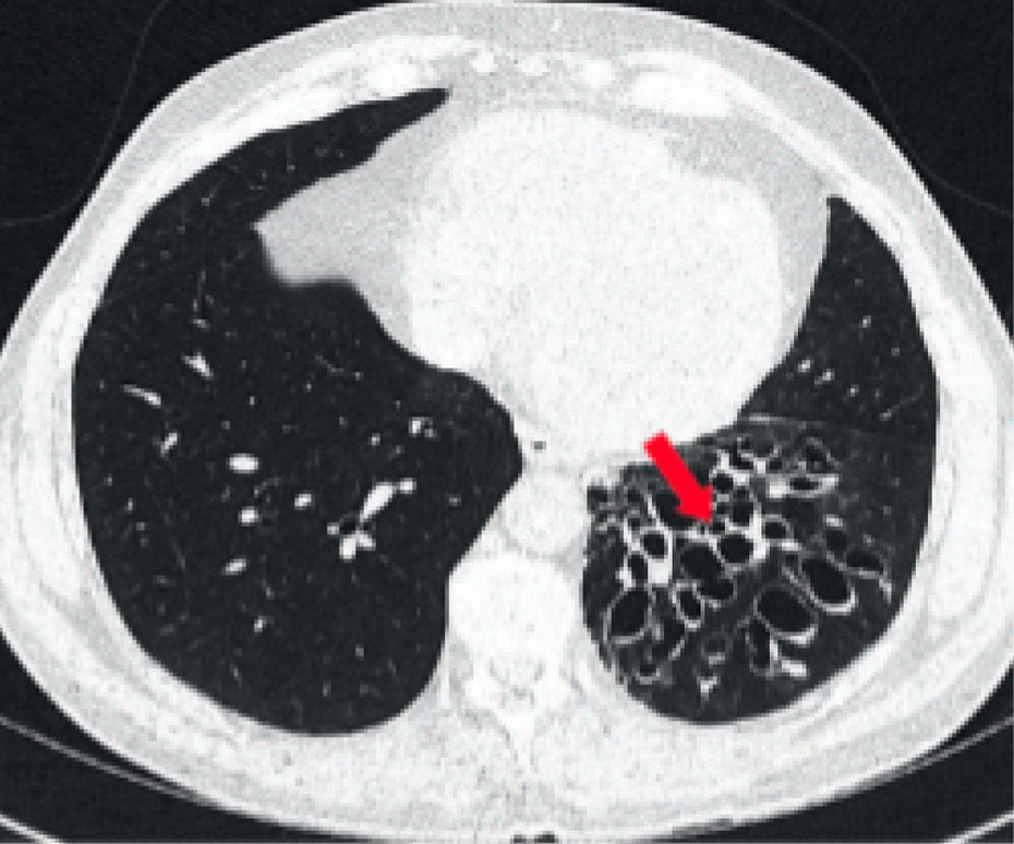 CT Thorax Aufnahme komorbide Bronchiektasen