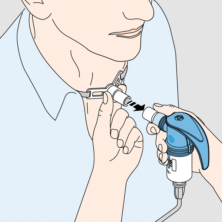 Schematic representation of a person with a tracheostomy who puts a special designed nebuliser to the tracheostomy