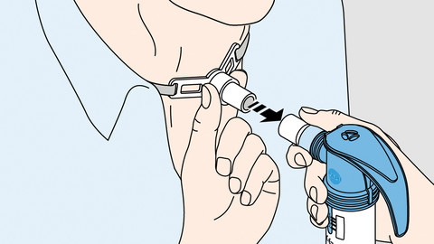 Schematische Darstellung eines Menschen mit Tracheostoma, der einen Vernebler zur Inhalation mit speziellem Adapter daran anschließt