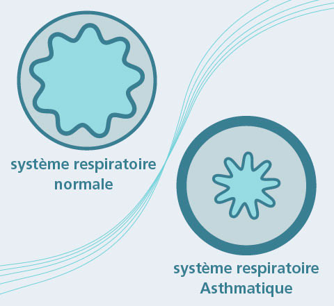 Systeme respiratoire Asthmatique