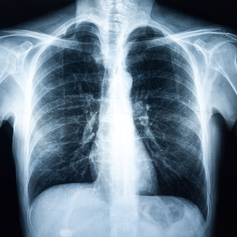 支气管炎诊断——病情加重时的检查