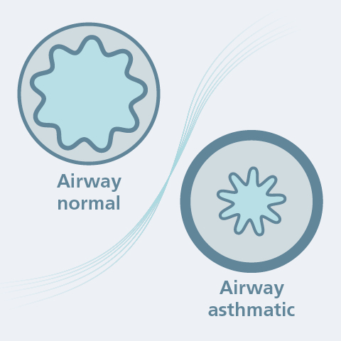 What exactly happens with asthma?