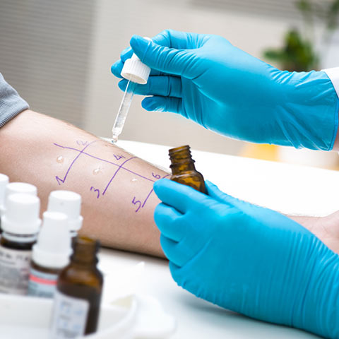 Allergietest auf einem Unterarm: Ein Arzt oder eine Ärztin mit blauen Schutzhandschuhen trägt mit einer Pipette Flüssigkeiten auf markierte Hautbereiche auf. Kleine Fläschchen mit Testlösungen stehen daneben.
