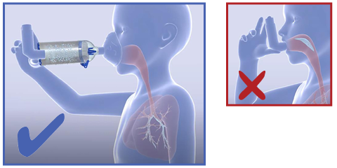 Inhalierhilfen sorgen bei Anwenderfehlern für weniger Nebenwirkungen im Rachen und mehr Wirkstoff in der Lunge