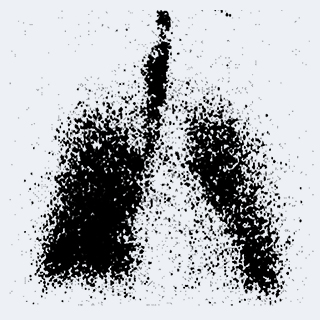 Deposition of the aerosol in the lungs