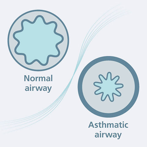 What is asthma?