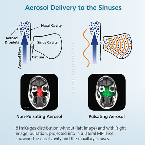 Therapy for the sinuses: Benefits from nebulization
