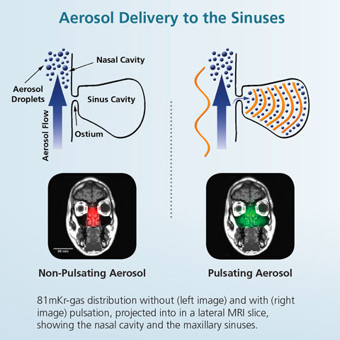 Sinus™ Pulsating Aerosol System - PARI